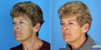 54 Year Old Weight Loss Surgery Patient Treated With Voluma Before By Dr Jason J. Hall, MD, FACS, Knoxville Plastic Surgeon