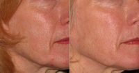 55 Year Old Treated With Voluma In Cheeks Before With Doctor Matthew Doppelt, DO, Knoxville Dermatologist