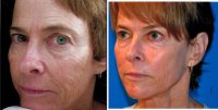 55 Year Old Woman Treated With Sculptra Before With Dr. E. John Serrao, MD, Orlando OB-GYN