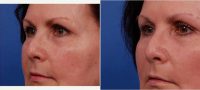 58 Year Old Woman Treated With Voluma Before With Dr. Thomas J. Walker, MD, FACS, Atlanta Facial Plastic Surgeon