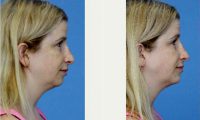 Doctor Anita Patel, MD, FACS, Beverly Hills Plastic Surgeon - 29 Year Old Woman Treated With Voluma To Chin Before