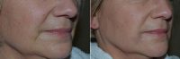 Doctor Michael M. Kim, MD, Portland Facial Plastic Surgeon - Radiesse Injection To The Marionette Lines
