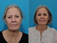 Doctor Rocco C. Piazza, MD, Austin Plastic Surgeon - Sculptra Treatment In A 72-year-old Female