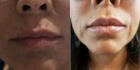 Doctor Stewart Wang, MD, FACS, Los Angeles Plastic Surgeon - 41 Year Old Woman Treated With Juvederm