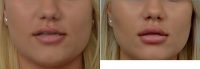 Dr David A. F. Ellis, MD, Toronto Facial Plastic Surgeon - 25 Old Woman Treated With Juvederm For Lip Asymmetry