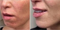 Dr John J. Corey, MD, Phoenix Plastic Surgeon - 30 Year Old Woman Treated With Juvederm