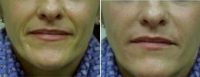 Dr Steven J. Rottman, MD, FACS, Baltimore Plastic Surgeon - 36 Year Old Woman Treated With Juvederm