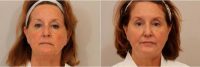 Dr. Connie Hiers, MD, San Antonio Plastic Surgeon - 60 Year Old Woman Treated With Voluma