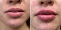 Dr. John J. Corey, MD, Phoenix Plastic Surgeon - 37 Year Old Woman Treated With Juvederm