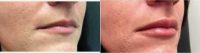 Dr. Philip A. Alves, MD, Toronto Physician - 29 Year Old Woman Treated With Juvederm