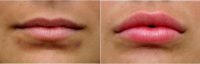 Dr. Ryan Greene, MD, PhD, Fort Lauderdale Facial Plastic Surgeon - Juvederm To Add Volume And Naturally Roll The Lips Outward