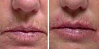 Dr. Ted Lain, MD, Austin Dermatologist - 61 Year Old Woman Treated With Juvederm