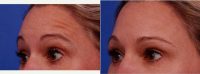 Dr. Thomas J. Walker, MD, Atlanta Facial Plastic Surgeon - 47 Year Old Woman Treated With Botox, Treatment Areas Include Glabella, Lateral Forehead