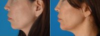 Dr. Tim Neavin, MD, Beverly Hills Plastic Surgeon - 40 Year Old Woman Treated With Radiesse