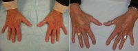 Hand Rejuevnation With Radiesse Before With Doctor Shahram Salemy, MD, FACS, Seattle Plastic Surgeon