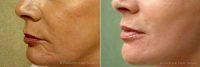 Juvederm Before By Doctor Frank Campanile, MD, Denver Plastic Surgeon