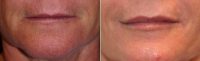Juvederm Filler To The Lips Before With Doctor Theda C. Kontis, MD, Baltimore Facial Plastic Surgeon