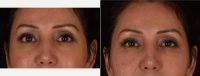 New  Innovative Approach To Hyaluronic Acid Injectables Before With Doctor Kian Karimi, MD, FACS, Los Angeles Facial Plastic Surgeon