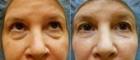 Under-Eye Filler Treatment Before By Dr Jennifer Reichel, MD, Seattle Dermatologist