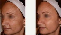 Voluma For Cheek Lift And Lip Rejuvenation Before By Dr Andrea Hui, MD, San Francisco Dermatologic Surgeon