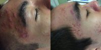 17 or under year old man treated with Laser Treatment