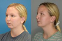 18-24 year old woman treated with Chin Implant