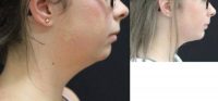 18-24 year old woman treated with Chin Implant