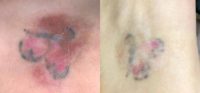 18-24 year old woman treated with Laser Treatment