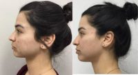 18-24 year old woman treated with Microneedling