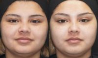 20 year old woman treated with Botox