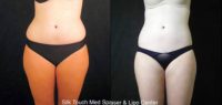 18-24 year old woman treated with Laser Liposuction