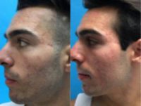 18-24 year old man treated with Microneedling