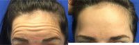 23 year old desiring preventative treatment of forehead wrinkles