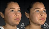 18-24 year old woman treated with Buccal Fat Removal
