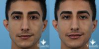 18-24 year old man treated with Lip Augmentation