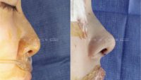 18-24 year old woman treated with Asian Rhinoplasty with DCF