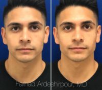 18-24 year old man treated with Injectable Fillers