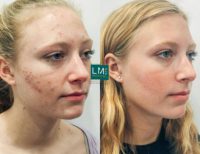 18-24 year old woman treated with Acne Treatment