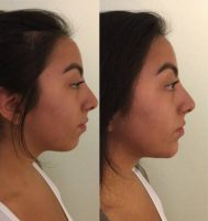 18-24 year old woman treated with Restylane Lyft
