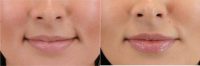 25 year old woman treated with Restylane Kysse
