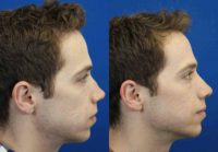 25 year old male with a twisted nose treated with Rhinoplasty