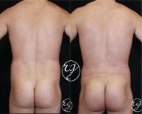 25-34 year old man treated with Butt Augmentation