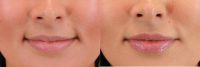 25 year old woman treated with Restylane Kysse in the Lips