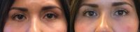 25-34 year old woman treated with Restylane Lyft for under eye bags