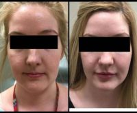 25-34 year old woman treated with Volbella