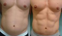 27 Year old male treated with power assisted tumescent liposuction