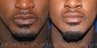 25-34 year old man treated with Injectable Fillers