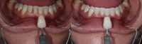25-34 year old man treated with Zoom Whitening
