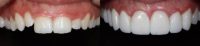 25-34 year old woman treated with Porcelain Veneers