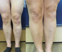 25-34 year old woman treated with Sclerotherapy